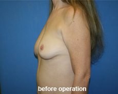 plastic-surgery-breast-augmentation
